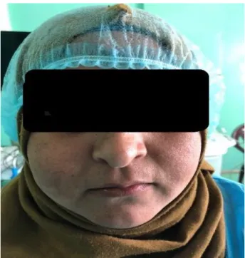 Figure 1: The face was gently asymmetrical because  of right cheek swelling. 