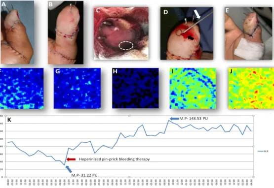 Figure 5: (A-E) Visual appearance changes of a 50-year-old male, replanted rt. thumb (machine crush injury,  Tamai zone II amputation) on 0, 1st, 3rd, 5th, and 8th post-operative days, respectively, along with their  corresponding LSCI images (F- J); white