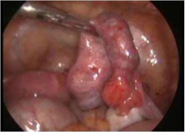 Figure  3:  Extraction  of  the  trophoblast  after  salpingotomy 