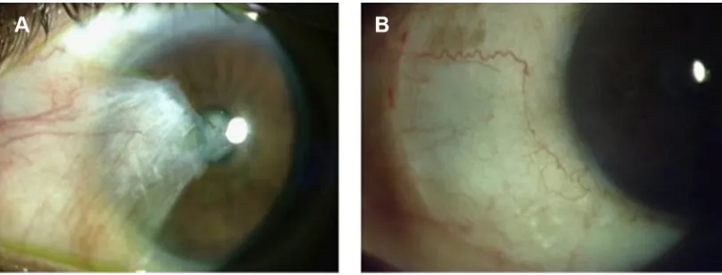 Figure 1 Clinical photograph of primary pterygium before surgery (A) and following superior conjunctival autograft (B).