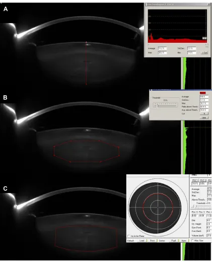 Figure 1 Densitometric analysis modes.Notes: (A) linear mode evaluates the density of a vertical line manually drawn along the axial length of the crystalline lens (red line)