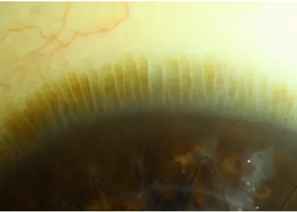 Figure 1 Slit-lamp photograph of the palisades of vogt at the limbus of an eye with a healthy ocular surface.Note: Keratoplasty sutures can be seen inferiorly.