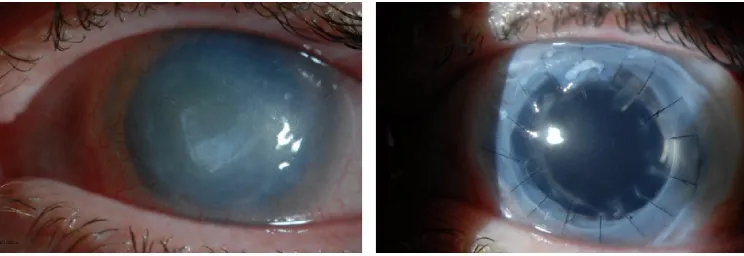 Figure 5 Combined penetrating keratoplasty and simple limbal epithelial transplantation.Notes: Patient with history of Acanthamoeba infection, with scarring and limbal stem cell deficiency (left panel)