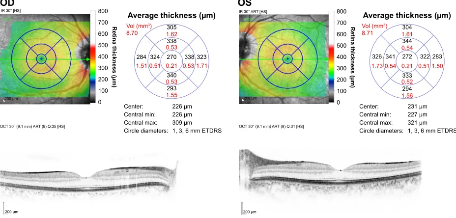 Figure 5 The optical coherence tomography report of the maculae of right and left eyes.Abbreviations: OD, oculus dexter (right eye); Os, oculus sinister (left eye); eTDrs, early Treatment Diabetic retinopathy study.