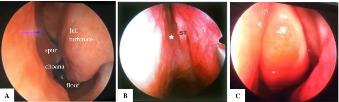 Figure 1: Structures visualized on diagnostic nasal endoscopy. (A) 1st pass structures; (B) 2nd pass structures;                (C) 3rd pass structures showing concha bullosa obstructing the region of OMC and middle meatus