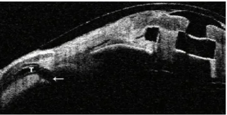 Figure 1 Forniceal scarring documented in a patient during a preoperative evaluation for keratoprosthesis.Note: These patients should undergo fornix reconstruction to allow bandage contact lens placement.