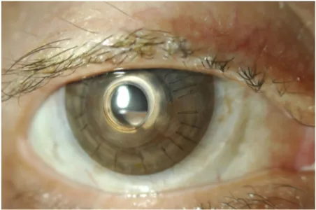 Figure 3 Bandage contact lens tinted to match the fellow iris and improve cosmesis.