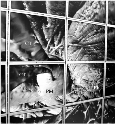 Figure 3. Comparison between two identical views of the isosurfaced left ventricle in the(a) absence and (b) presence of additional MRI slices overlayed onto the two-dimensional surface.