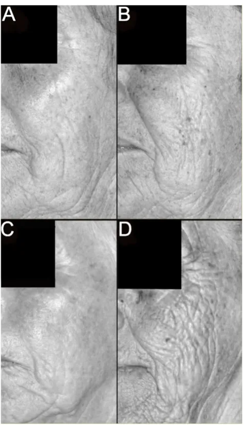 Figure 3. Example of the most discordant monozygotic twinpair (68 years of age, perceived facial age a 63 years and b 68images illustrate the greater differences in skin wrinkling that was foundbetween dizygotic twins compared to monozygotic twins