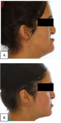 Figure 2: Facial profile of the patient: (A) Before  distraction osteogenesis. (B) After distraction 