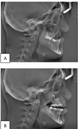 Figure 3: Lateral cephalometric radiograph of the  patient: (A) Before orthodontic treatment and 