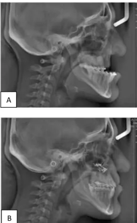 Figure 6: Lateral cephalometric radiograph of the  patient: (A) Before distraction osteogenesis