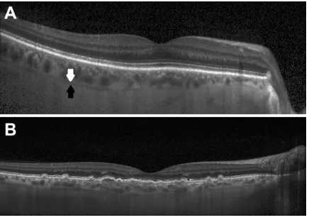Figure 1 imaging of the suprachoroidal space.Notes: (A) An EDi-OCt scan of a healthy 67-year-old patient