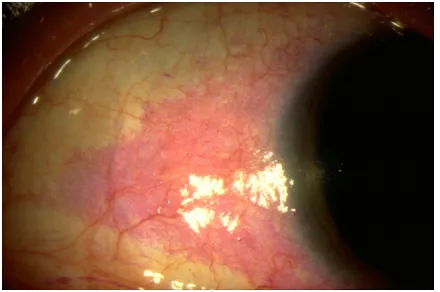Figure 2 Ocular surface of a dry eye patient following Rose Bengal application.Notes: Purple stained areas indicate devitalized tissue and epithelial cell damage