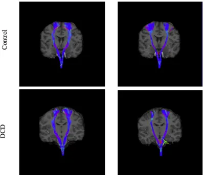Fig. 1. A visual representation of CST tracts using CSD and DTI modelling in a representative individual with DCD and a control participant