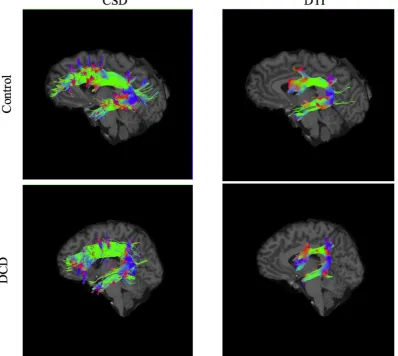 Fig. 3. A visual representation of ROI masks for the CST. NOTE: ROI: Region of interest; CST- corticospinal tract.
