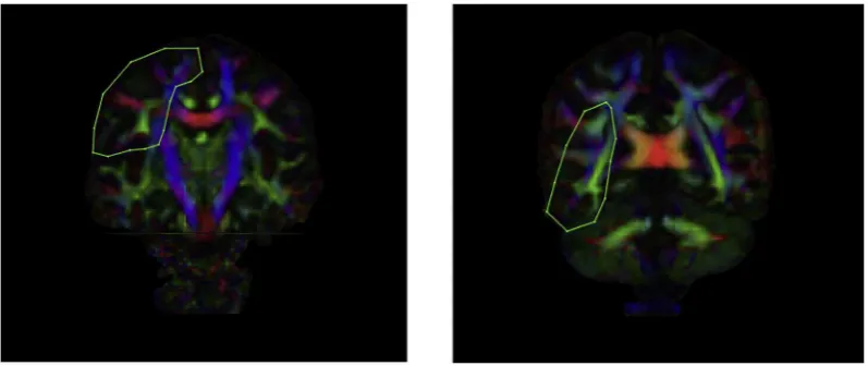 Fig. 4. A visual representation of ROI masks for the SLF. NOTE: ROI: Region of interest; SLF- superior longitudinal fasciculus.