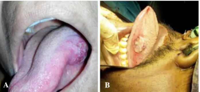 Figure 1 (A, B): cT2 left lateral border oral tongue.  Incisional  biopsy  was  taken  from  the  tumour  and  pathological  evaluation  was  done  for  differentiation  of  the  tumour  and  assessment  of  lymphovascular  and  perineural  invasion