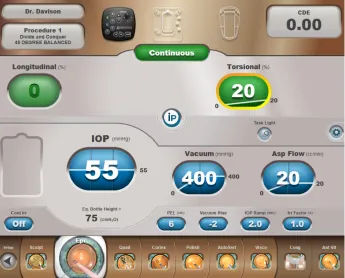 Figure 3 Video freeze frame of third quadrant removal.Notes: At 6.8 seconds, the third quadrant has been acquired and phacoemulsification continues to be carefully accomplished while trying to stay away from the capsular defect
