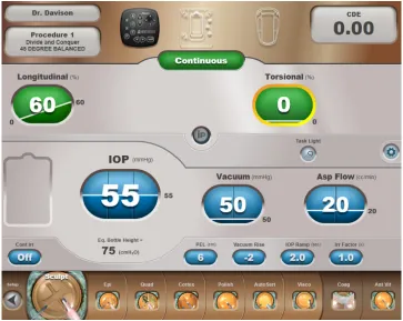 Figure 5 The machine screen display of the Sculpt Setting (Sculpt Procedure Step Button enlarged in the procedure step toolbar) shows low fixed values for vacuum and aspiration flow and linear control of continuous longitudinal tip motion.Note: These parameters provide just enough vacuum and flow to aspirate the mix of nuclear dust in balanced salt solution.Abbreviation: IOP, intraocular pressure.