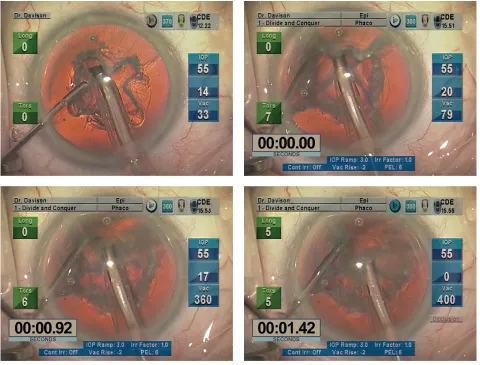 Figure 6 Soft cataract technique using the Epinucleus Removal Setting.Notes: Top Left shows the Balanced Tip is turned slightly obliquely (aperture away from the surgeon) so that better visualization of its distal edge on the posterior nuclear plate is ava