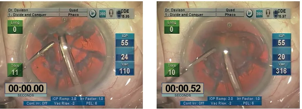 Figure 7 Removal of the second and subsequent quadrants of relatively firm soft lenses using the Quadrant Removal Setting.Notes: With the timer set at 0 seconds (left) the second quadrant is about to be engaged using the quadrant removal setting
