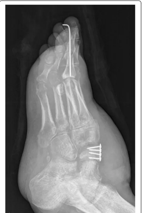 Fig. 1 Preoperative view of the injured foot