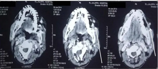 Figure 3: Baseline CT scan of patient with carcinoma buccal mucosa before initiation of treatment, arrow pointing  towards tumor site
