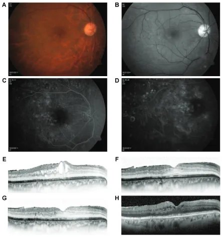 Figure 1 A 64-year-old male diagnosed with diabetic macular edema in the right eye.Notes: Color and red-free fundus photographs of the Re indicate thickening of the fovea, as well as intraretinal small hemorrhages and microaneurysms (A and B)