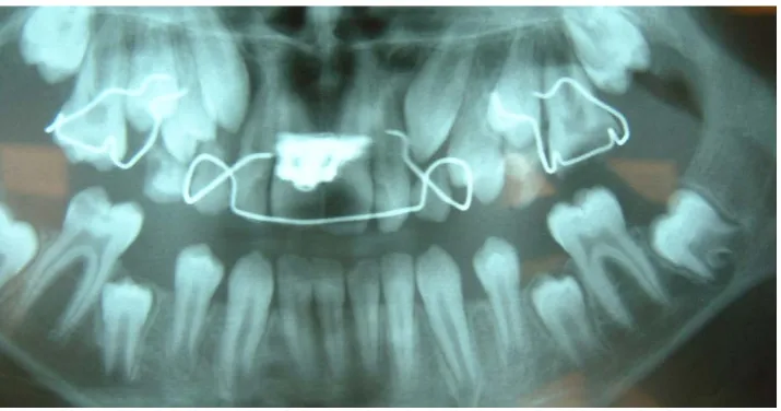 Figure 1. This panoramic was taken exactly before the extraction of the upper left first molar