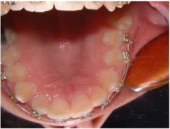 Figure 2. The same patient after 6 months of extraction of the upper left first permanent molar