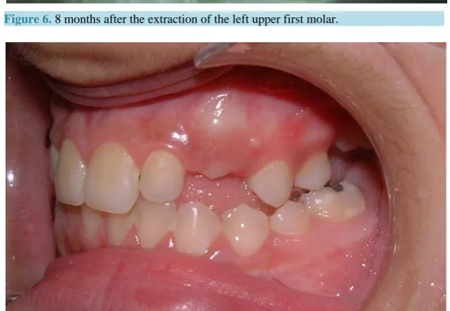 Figure 5. 16 months after the extraction, the upper second molar erupted in place and without any cross bite or tilting
