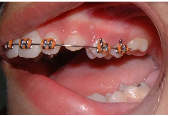 Figure 9. Exactly before the extraction of the left and right upper permanent first molars