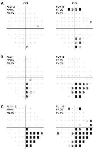 Figure 1 Humphrey visual field stimulus III 24-2 pattern deviation plots for case 1.Notes: (A) At time of presentation, (B) 10 weeks and 6 days later, and (C) 14 weeks and 2 days from time of presentation.Abbreviations: FL, fixation loss; FP, false positive; FN, false negative.