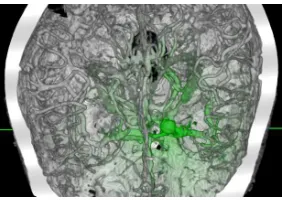 Figure 1: Mapping effects in 3D: (a) no effects; in (b) the bifocal effect helped to distinguish between the focus and context regions;in (c) the ﬁsheye effect better preserved the spatial relationships of the data; in (d) the volume lens effect produced a magniﬁed viewof just the focus region.