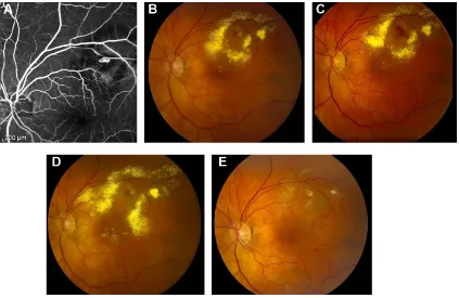 Figure 1 Fluorescein angiography and fundus photographs.Notes: (A) Fluorescein angiogram demonstrating a superotemporal macroaneurysm with surrounding leakage and blockage by blood