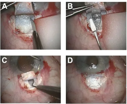 Figure 1 Surgical technique of modified filtering trabeculotomy. Notes: (A) A rectangular half-thickness scleral flap is created