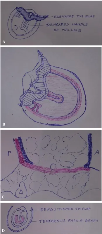 Figure 1: Schematic representation of the surgical  procedure. (A) Extent of elevation of tympanomeatal  flap, keeping pedicle over the malleus; (B) Temporalis 