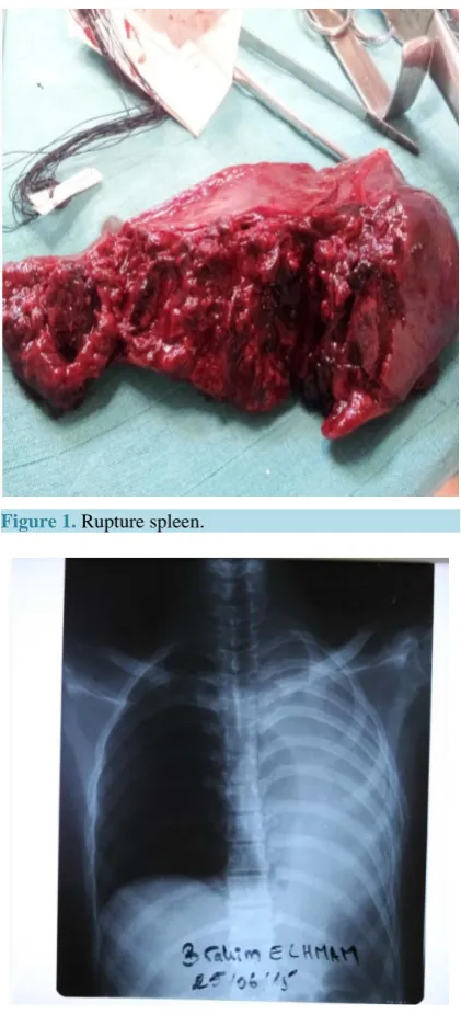 Figure 1. Rupture spleen.                           