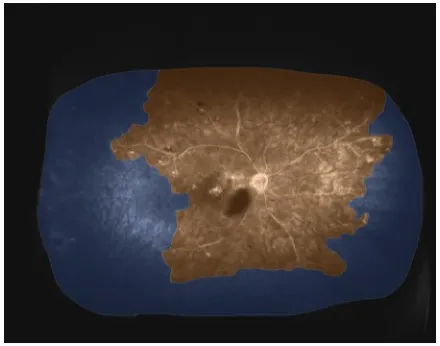 Figure 1 Widefield FA prior to treatment.Notes: areas of nonperfusion are shaded blue, while areas of perfusion are orange