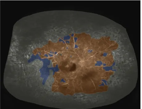 Figure 2 Widefield FA after initial targeted retinal photocoagulation.Notes: areas that have been lasered are shown in grey