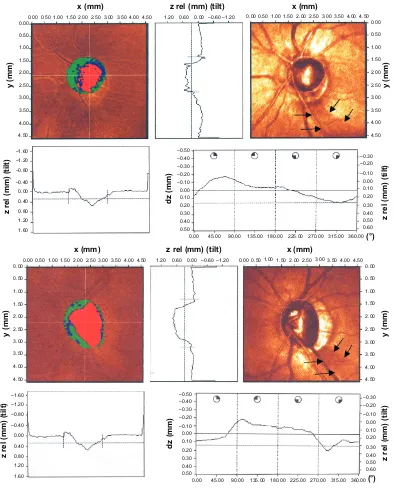 Figure 1 Heidelberg retinal tomography version II surface reflectivity image showing nerve fiber layer defects (arrows).