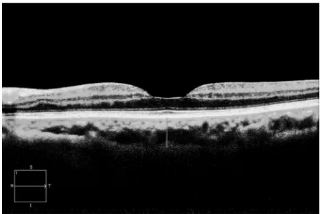 Figure 1 From cirrus high-definition Optical Coherence Tomography, high-definition one-line raster-scan protocol with capturing 20 B-scans at a single location and applying unique Selective Pixel Profiling™ software on enhanced depth imaging modeto obtained high quality image.