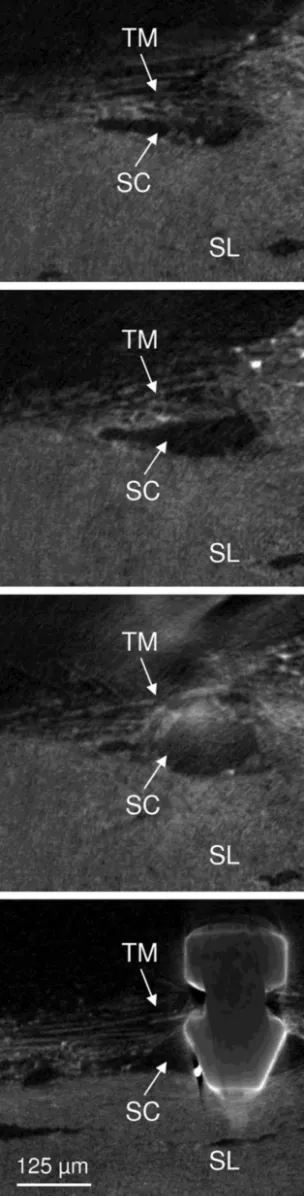 Figure 6 Three-dimensional micro-computed tomography views showing dilatation of Schlemm’s canal (SC) after implantation of the iStent inject, in relation to the trabecular meshwork (TM) and sclera (SL).Notes: Reprinted from Bahler CK, Hann CR, Fjield T, H
