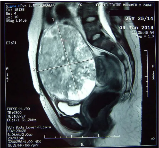 Figure 1 : IRM pelvienne coupe sagittale montrant une grosse masse ovarienne solidokystique 
