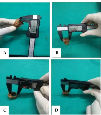 Figure 3: Some of the measurements recorded using  the caliper on the cricoid cartilage