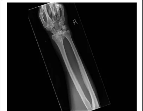 Fig. 7 Pre- and post-manipulation radiographs of a 33-year-old ladywith a right distal radius fracture