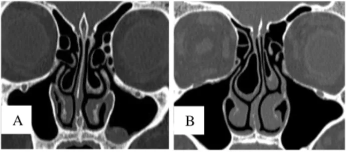 Figure 3: Coronal CT scan. 