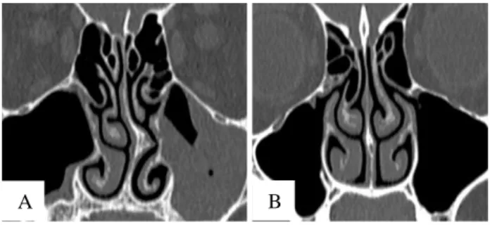 Figure 4: Coronal CT scan. 
