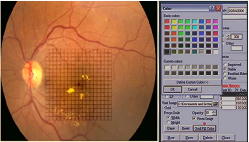 Figure 1 software used to import the fundus image from the patient. The laser criteria used are selected from the menu.